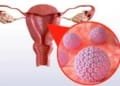 Human Papillomavirus