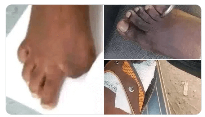 At Zimbwabwe Citizens Sell Toes In Dollars To Get Rich