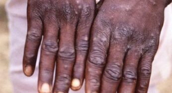 Monkeypox: Adamawa Confirms 5 Cases, Examining 57 Cases