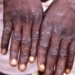 Monkeypox: Adamawa Confirms 5 Cases, Examining 57 Cases