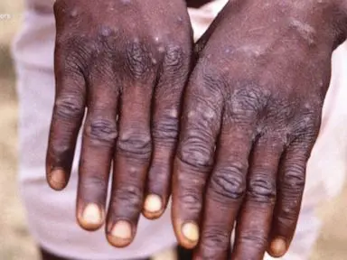 Monkeypox: Adamawa Confirms 5 Cases, Examining 57 Cases