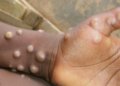 Mpox Outbreak